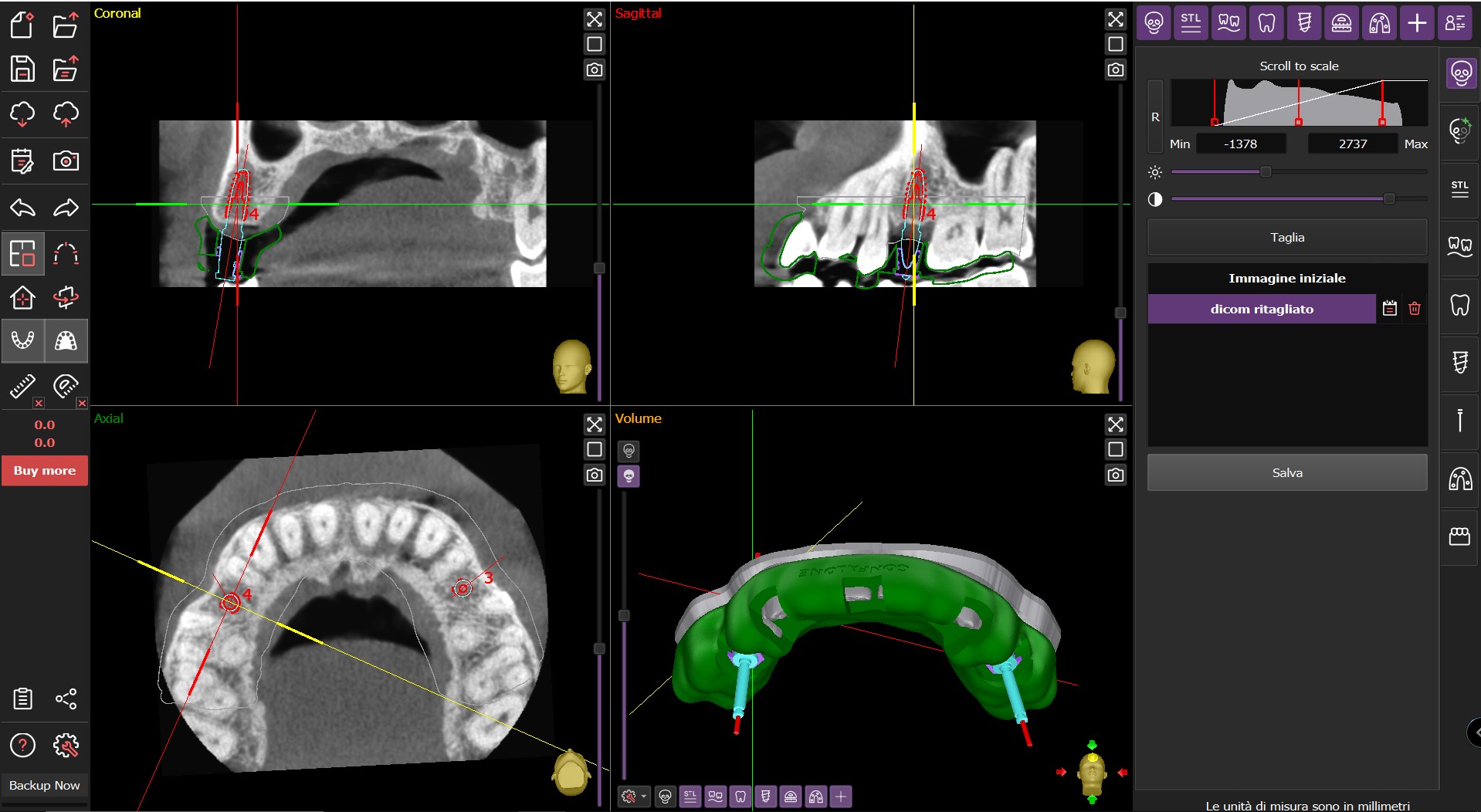 Progettazione implantare 3D - vista completa